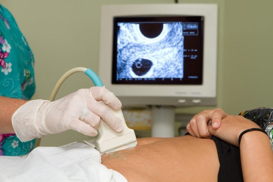 Sonograp Ultraschall Baby schwanger Abtreibung