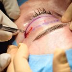 Schönheitschirurg Operation Auge