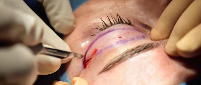 Schönheitschirurg Operation Auge