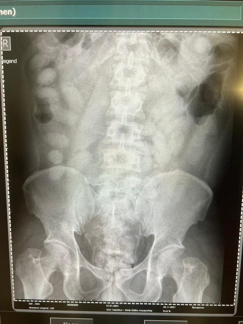 Röntgenbild des Körperschmugglers