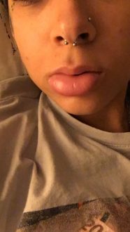 Amber N. zeigt ihre geschwollene Lippe 