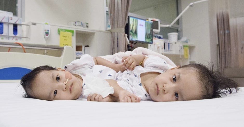 In einer sechsstündigen Operation haben Ärzte in Australien am Freitag siamesische Zwillinge aus dem Himalaya-Staat Bhutan erfolgreich getrennt. Die beiden 15 Monate alten Mädchen namens Nima und Dawa